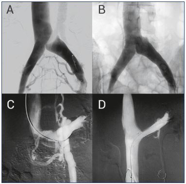 Figure 4. Treating compressive syndromes with stenting. Panel A. May-Thurner syndrome or compression of left iliac vein is shown in this pelvic phlebography. The presence of collateral pathways in the uterine and pelvic plexus is responsible for the PCS symptoms. Panel B. After placing a stent, normal blood flow is reestablished, avoiding pathologic collateral systems. Panel C. Nutcracker syndrome or left renal vein compression is shown in the pelvic phlebography. In this case, the pressure increase develops an insufficiency in the left gonadal vein, with the concurrence of an ascending paravertebral collateral system. Panel D. The left renal vein compression is corrected with a stent, which again reestablishes normal blood flow.