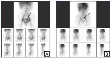 Figure 3. ECT assessment of pelvic veins before and after MPFF treatment. ECT of the pelvic veins at baseline (Panel A) and after an 8-week MPFF treatment (Panel B) in a patient with pelvic vein dilation in isolated PVV. Deposit of labeled erythrocytes in the uterine venous plexus is indicated by the arrows. Abbreviations: ECT, emission computed tomography; MPFF, micronized purified flavonoid fraction; PVV, pelvic varicose veins. From reference 39: Gavrilov et al. Angiol Sosud Khir. 2012;18(1):71-75.