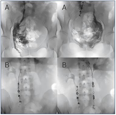 Figure 1. Reflux of gonadal veins can be treated by embolization. Panels A. Pelvic selective phlebography showing insufficient gonadal veins in the same patient (left and right gonadal veins). When a gonadal vein is refluxive, contrast media flows in a retrograde direction when injected into the proximal portion of the vein and even fills varicose uterine veins. Panels B. Assessment in the same patient after embolization using controlled released (left and right gonadal veins). It is important to occlude all insufficient axes by covering the entire vessel to avoid recidivism.
