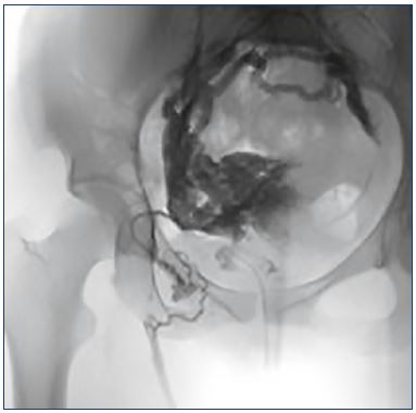 Figure 2. Pelvic leaking point to lower limbs through a round ligament vein. Pelvic congestion syndrome could affect the lower limbs, which is true in this example of an insufficient right gonadal axis that connects with the uterine-ovarian plexus, making those veins insufficient, and through the right round ligament vein (with a characteristic “C” shape) that connects with the great saphenous vein as a paraostial leak.