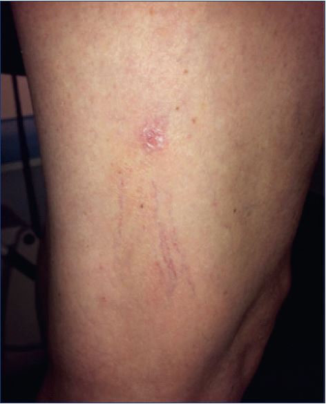 Cutaneous necrosis