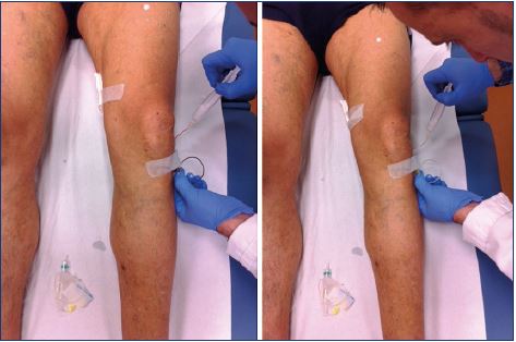 Indirect injection helps avoid intra-arterial injection or extravasation