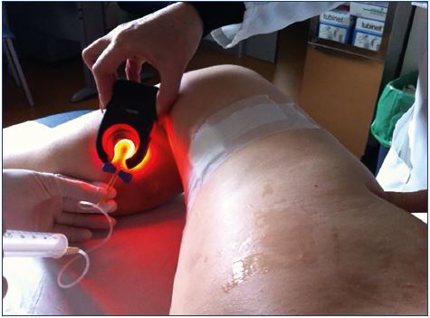 Injection with a transilluminator helps avoid extravasation and treat the underlying reflux, preventing matting appearance