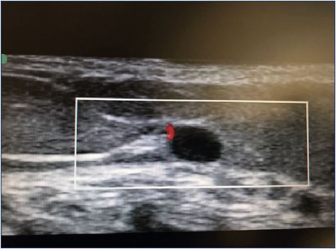 Satellite artery close to the small saphenous vein