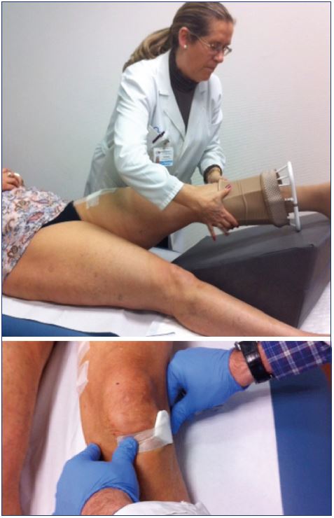 Medical compression systems have anti-inflammatory effects, decrease chronic venous hypertension, and help resolve intravascular coagula Physical prophylaxis (compression, movement) is recommended to prevent a venous thromboembolism