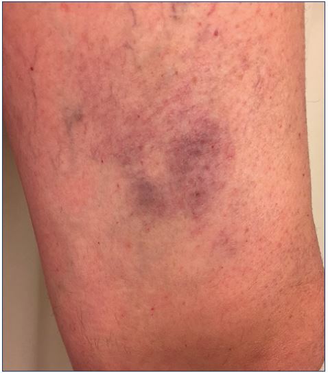 Matting after direct sclerotherapy of reticular veins and telangiectasias in the presence of an underlying saphenous reflux