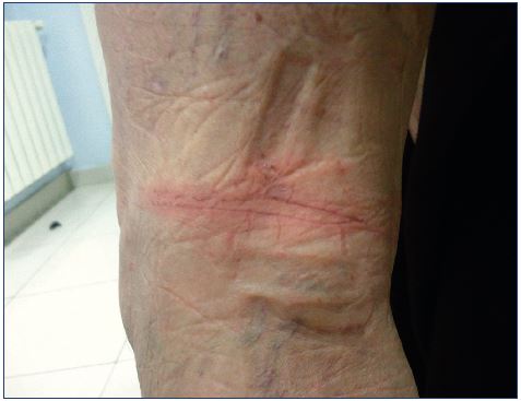 Skin irritation secondary to tape application behind the knees