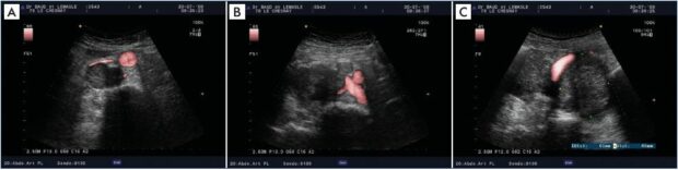 Iliocaval obliteration by extrinsic compression due to voluminous adenopathies