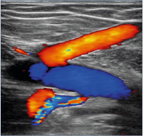 Replacement of an iliac venous obliteration by the saphenofemoral junction and a circumflex vein, afference of the common femoral vein, ie, inverted fluxes
